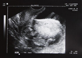 3 échographies en 9 mois de grossesse