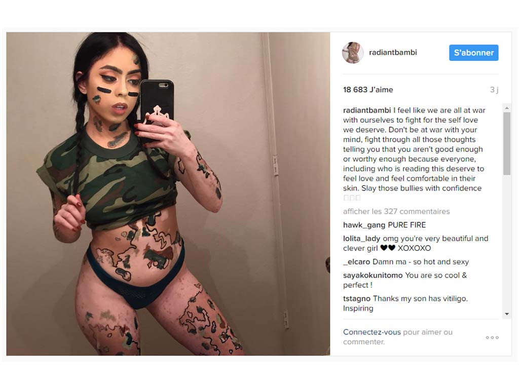 Atteinte de vitiligo, cette jeune femme transforme son corps en œuvre d’art