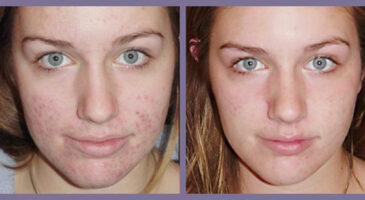 Comment faire un masque contre l’acné ?