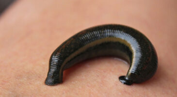 Une sangsue de 6cm retirée du corps d&rsquo;une petite fille de 6 ans