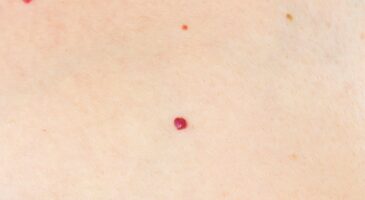C&rsquo;est quoi ces petits points rouges sur la peau ? L&rsquo;avis d&rsquo;un dermatologue s&rsquo;impose dans ce cas précis