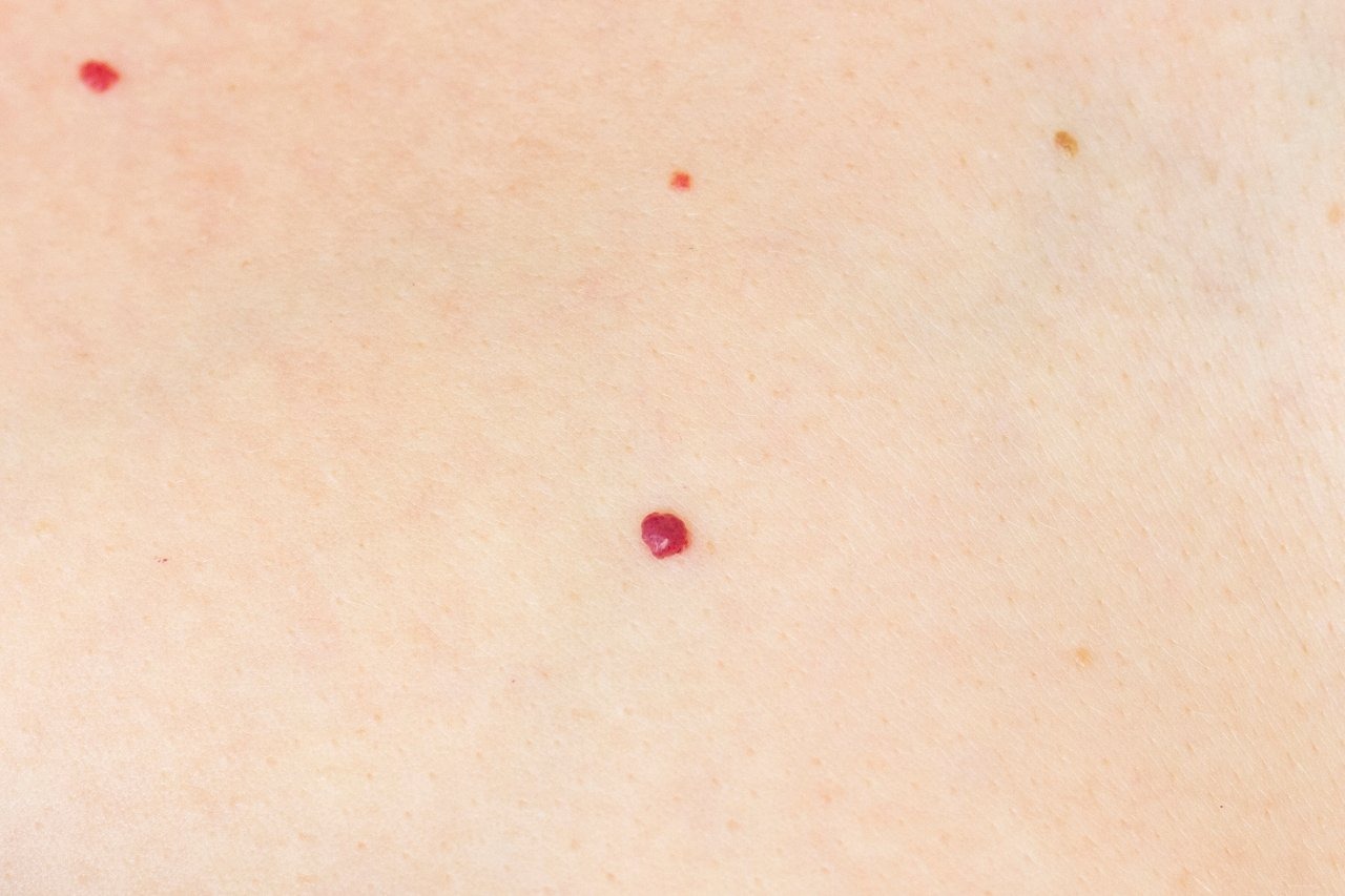 C&rsquo;est quoi ces petits points rouges sur la peau ? L&rsquo;avis d&rsquo;un dermatologue s&rsquo;impose dans ce cas précis